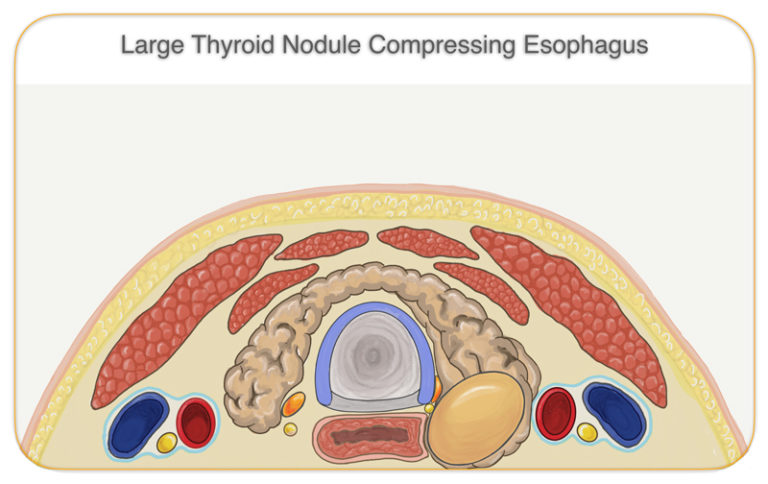 Goiter Larian Md