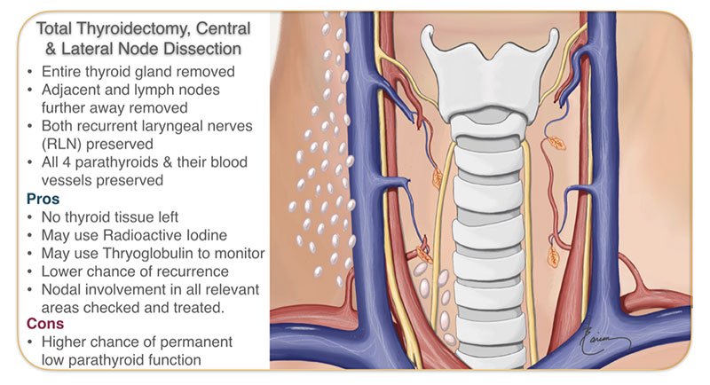 Minimally Invasive Thyroidectomy - Larian, MD