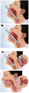 Zenker's Diverticulum Surgery - Larian, Md