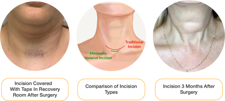 minimally-invasive-thyroidectomy-larian-md